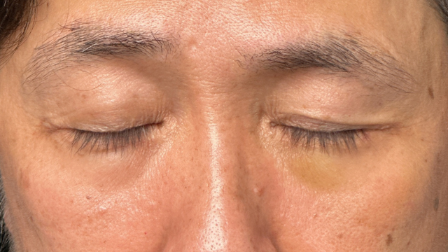 手术前的状态 其一