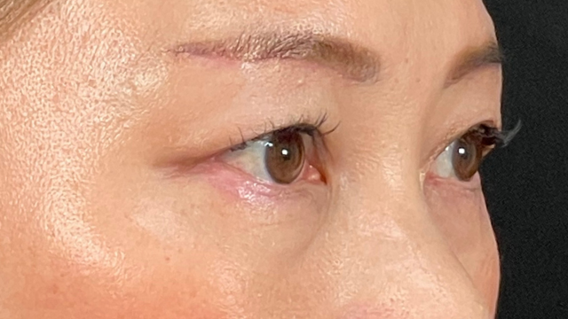 Postoperative Condition Part 1