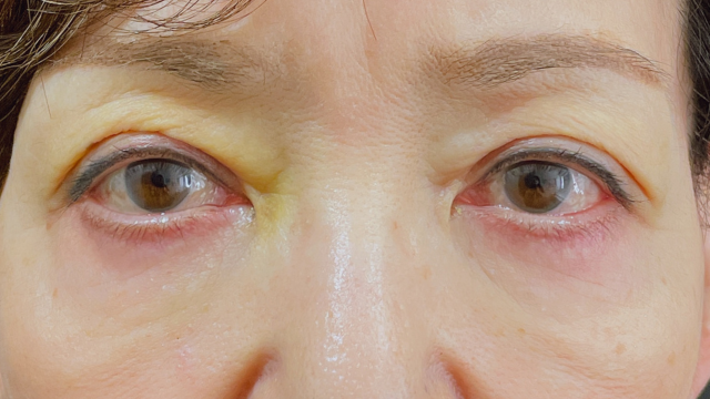 Postoperative Condition Part 1