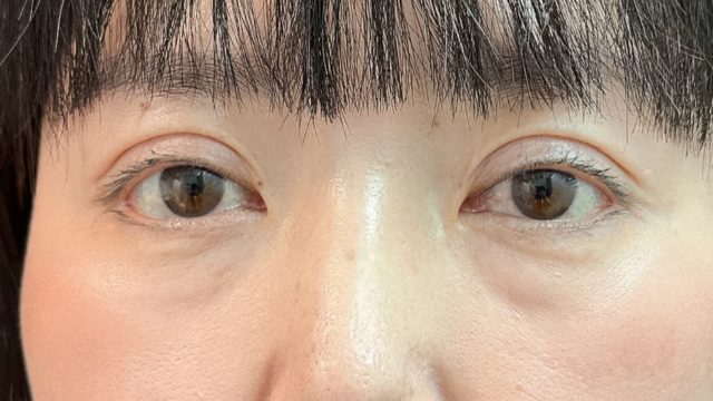 手術前の状態 その1