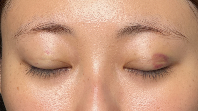 手術前の状態 その1