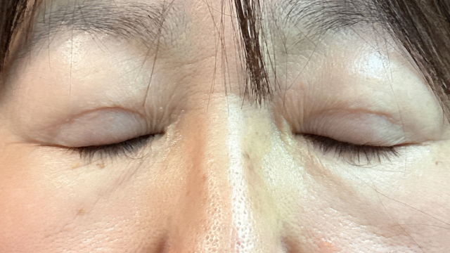 手术前的状态 其一