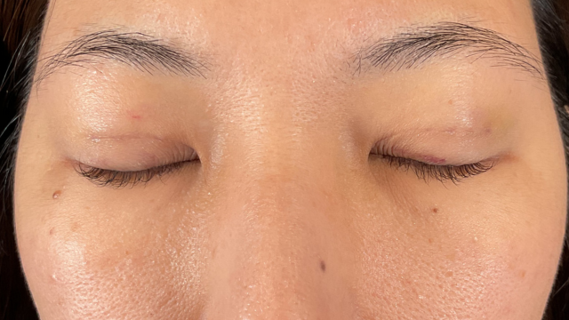 手術前の状態 その1