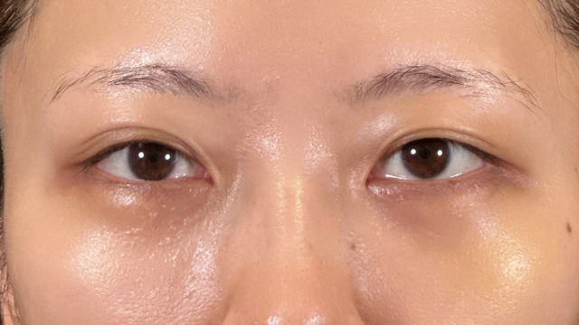 手术前的状态 其一