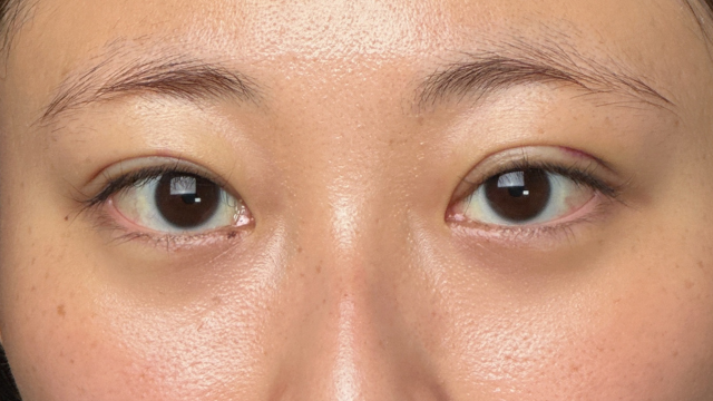 手術前の状態 その1