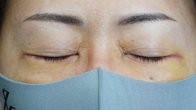 Postoperative Condition Part 1