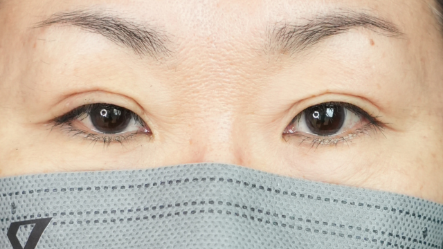 手術前の状態 その1