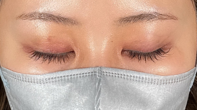 手术前的状态 其一