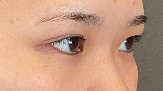 手術前の状態 その1