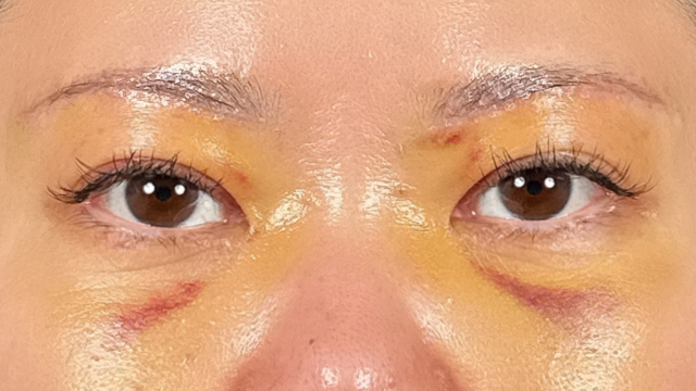 手术前的状态 其一