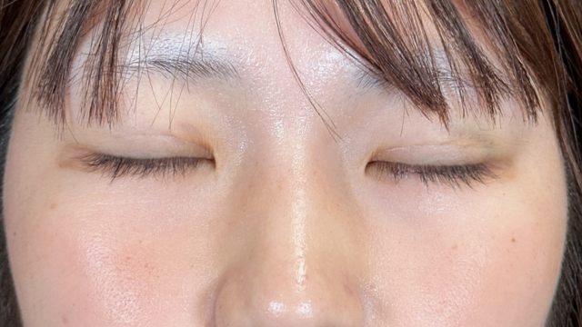 手術前の状態 その1