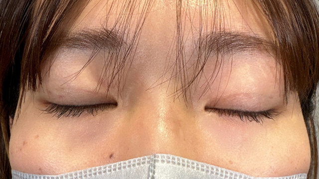 手術前の状態 その1