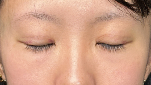 手术前的状态 其一