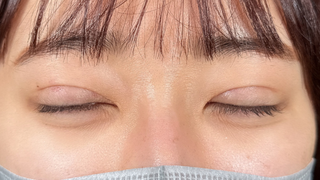 手术前的状态 其一