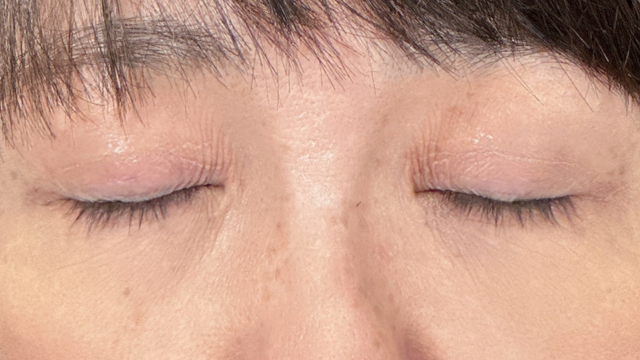 手术前的状态 其一