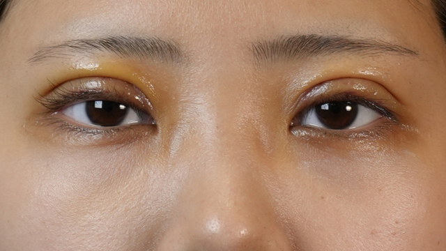 手術前の状態 その1