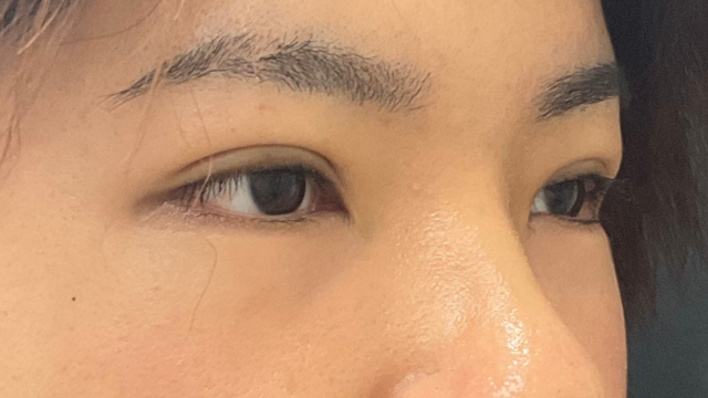 手術前の状態 その1