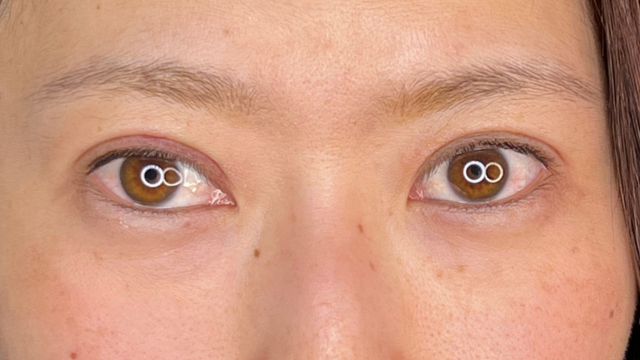 手术前的状态 其一