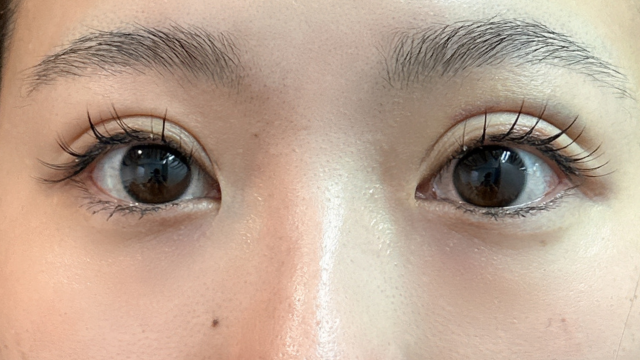 手術前の状態 その1