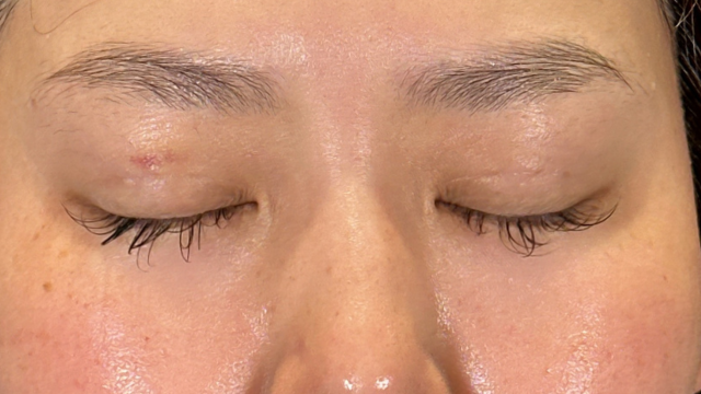 手术前的状态 其一