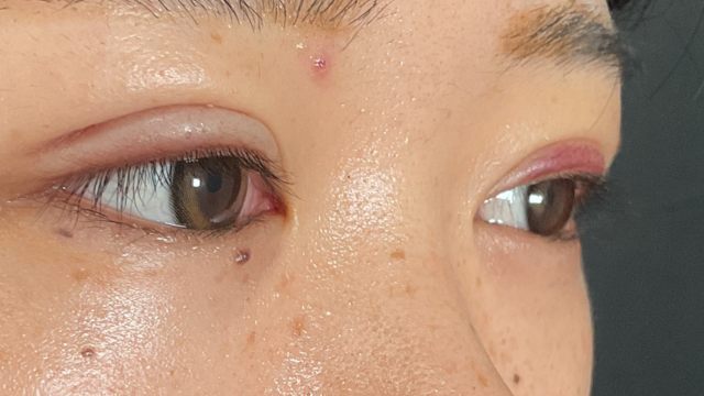 手术前的状态 其一