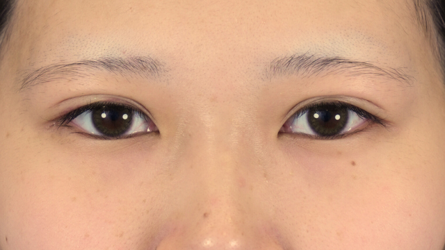 手術前の状態 その1