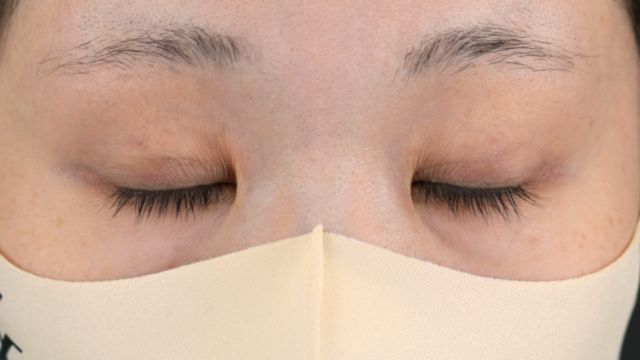 手术前的状态 其一