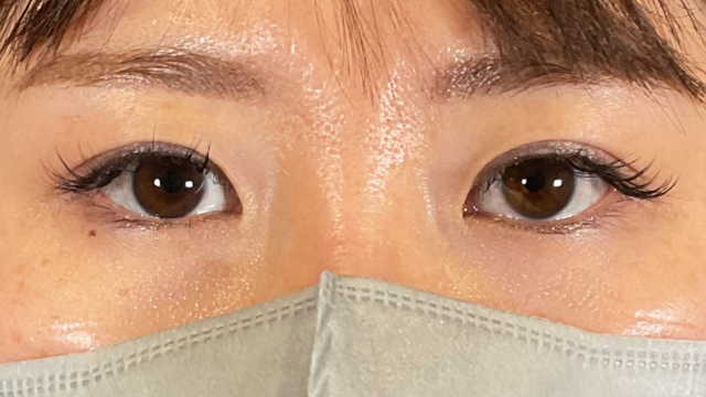 手术前的状态 其一