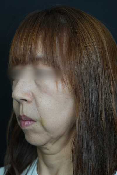 手術前の状態 その1