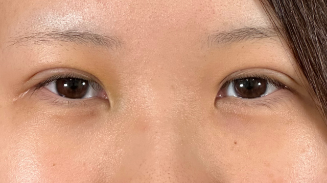 手术前的状态 其一