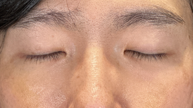 手术前的状态 其一