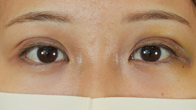 手術前の状態 その1