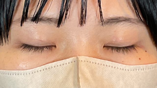 手术前的状态 其一