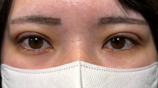 手術前の状態 その1