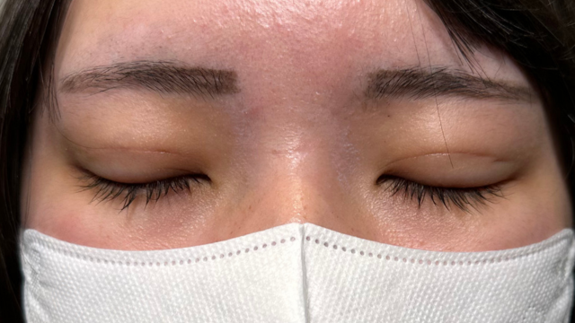 手術前の状態 その1