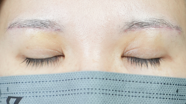 Postoperative Condition Part 1