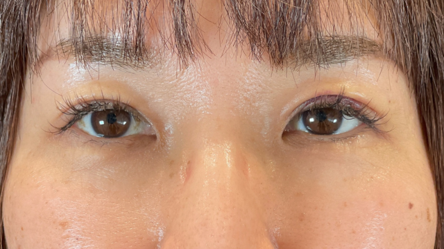 手术前的状态 其一