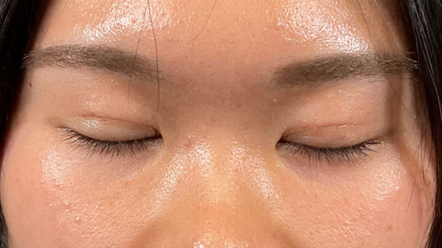 手术前的状态 其一