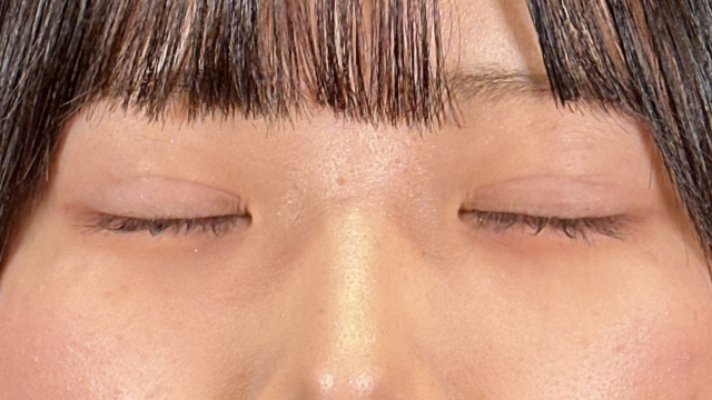 手術前の状態 その1