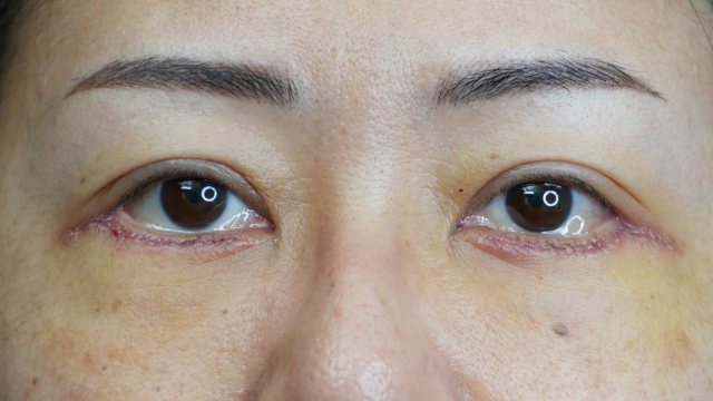 Postoperative Condition Part 1