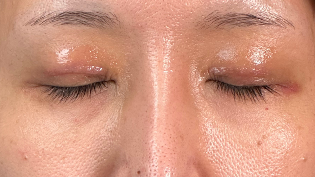 手術前の状態 その1