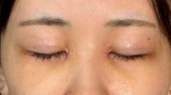 手術前の状態 その1