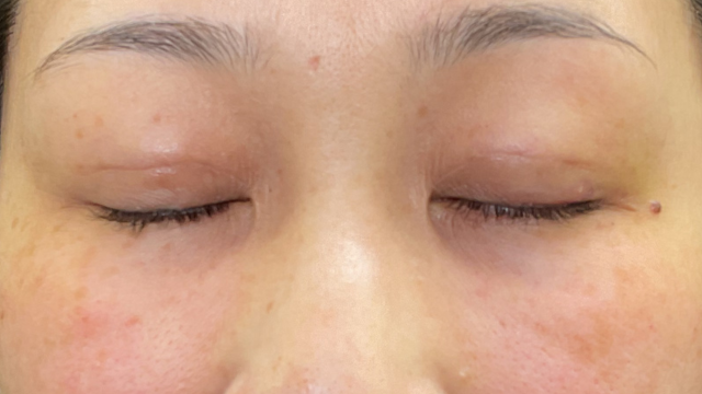 手术前的状态 其一