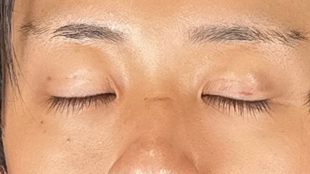 手术前的状态 其一