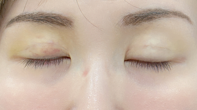 Postoperative Condition Part 1