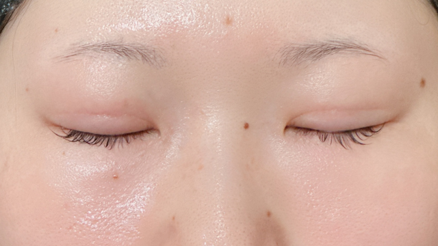 手术前的状态 其一