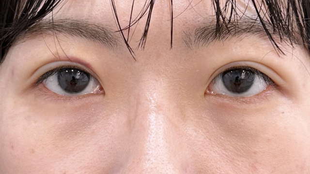 手術前の状態 その1