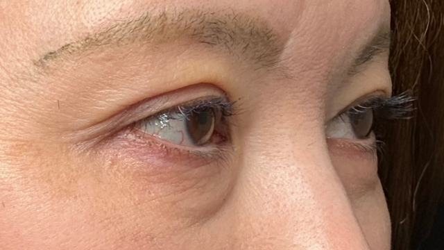 手术前的状态 其一