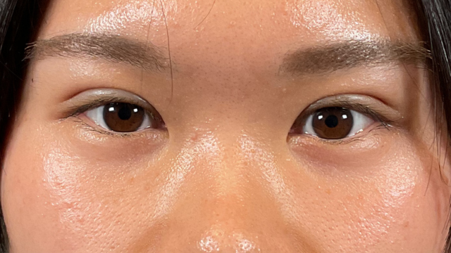 手术前的状态 其一