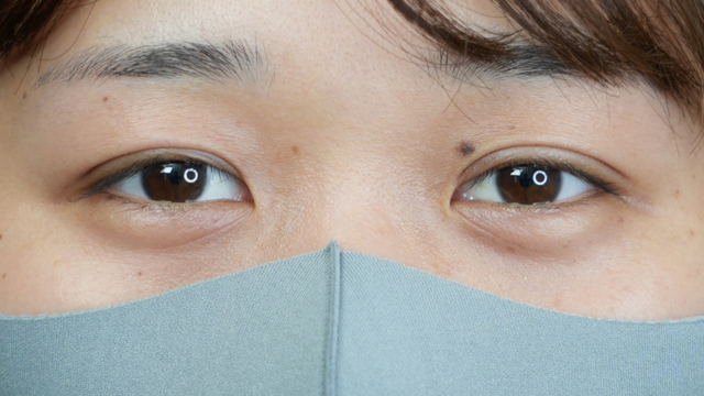 手術前の状態 その1